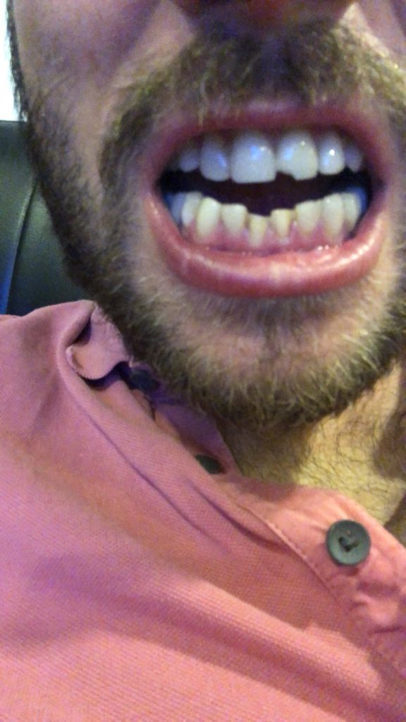 How Hard is it To Climb Aconcagua? | cracked veneers 1 Missing and cracked teeth
