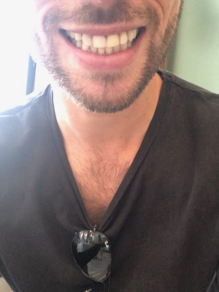 How Hard is it To Climb Aconcagua? | fixed veneers A full set of teeth and an open-mouthed smile after dental surgery