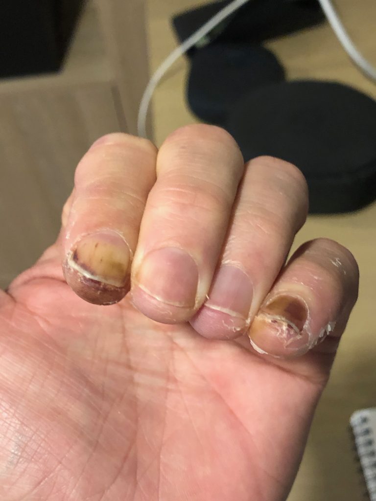How Hard is it To Climb Aconcagua? | healing frostbite 1 Healing frostbite in four fingers