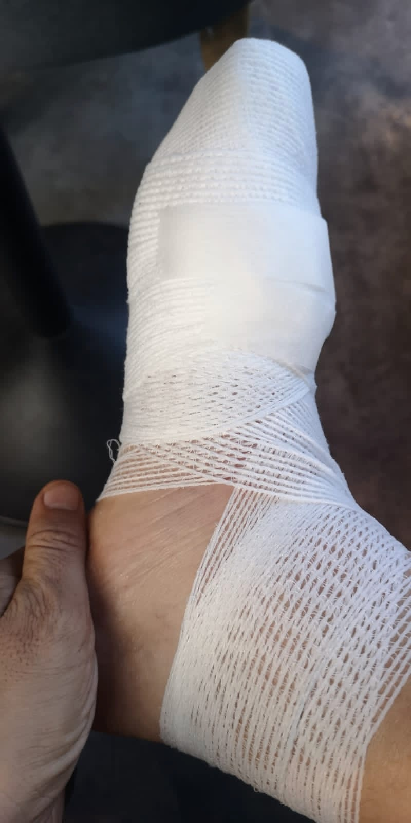 I Ran 200 Kilometres in a Weekend: My (RAW & Uncut) Story! | image 1 Heavily bandaged foot