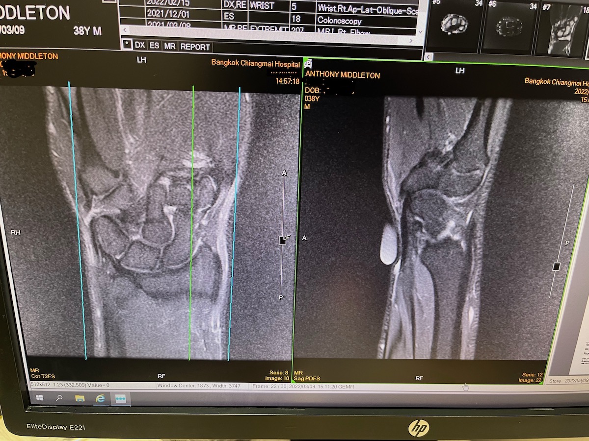SafetyWing Review (Digital Nomads Insurance & Expats) | MRI arm scan X-ray of a human arm