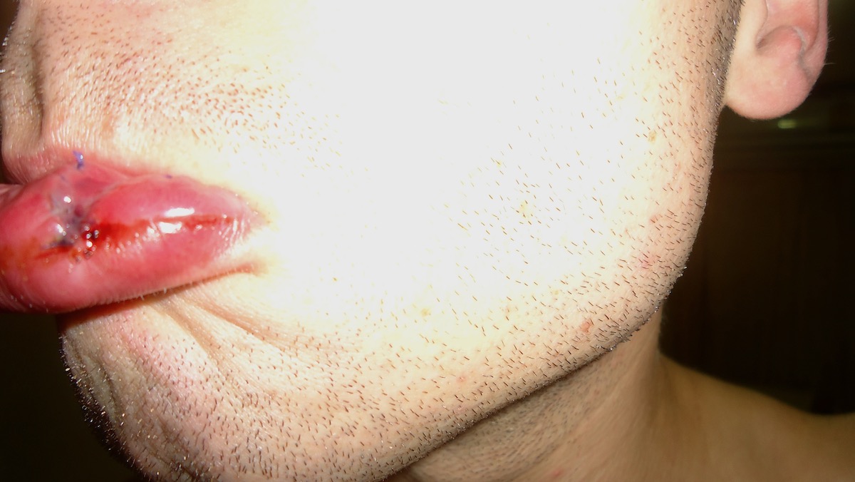 Plastic Surgery in Thailand, Broke & an Untimely Erection | plastic surgery in Thailand lips A man's lips with trauma after plastic surgery in Thailand
