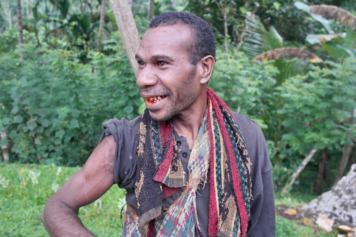 The Tribespeople of Papua New Guinea: A Detailed Guide | tribal conflict papua new guinea A Papua New Guinea tribesman shows off his battle scars from recent tribal warfare
