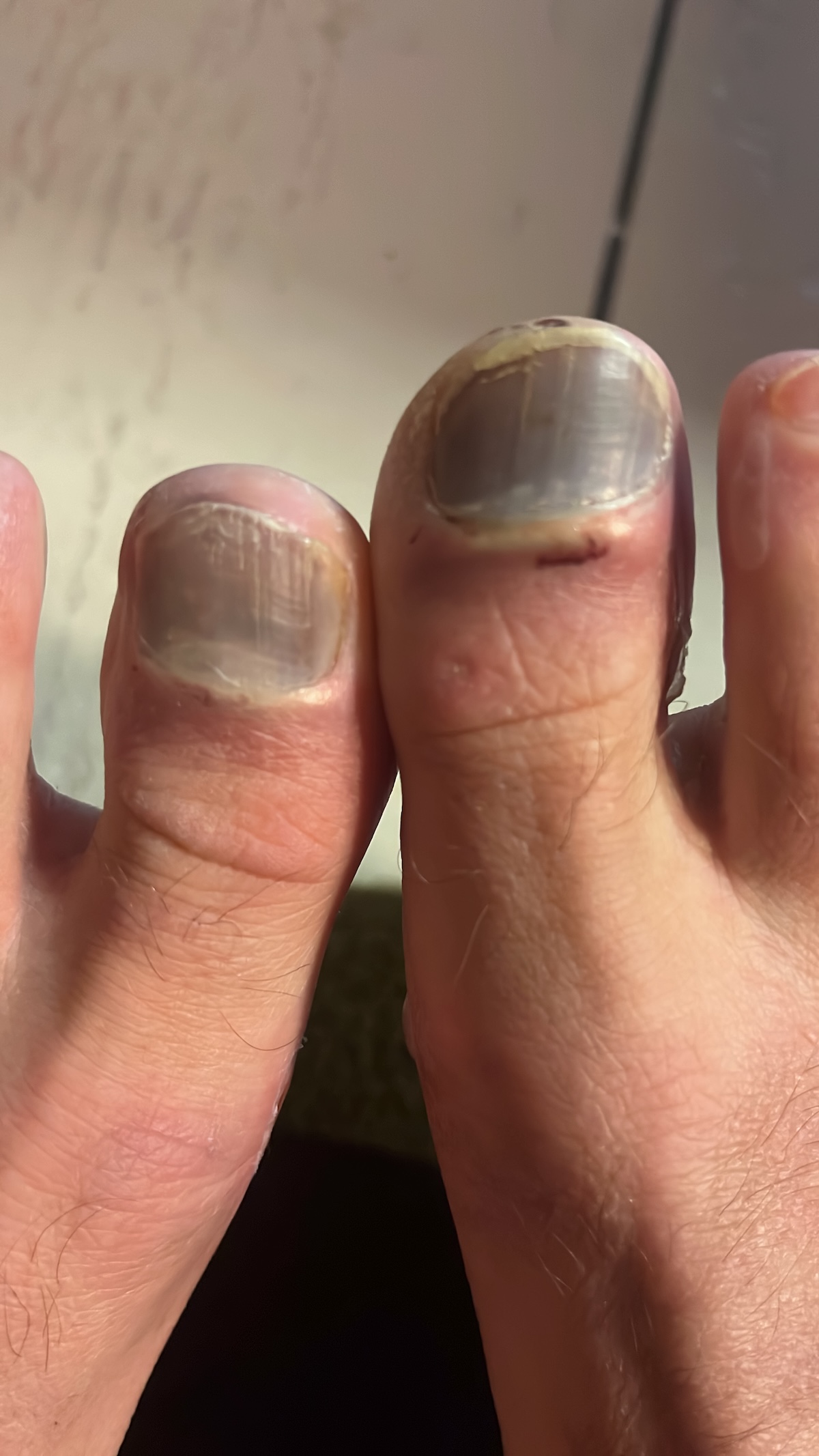 Running a 160km Ultramarathon in the Mauritanian Sahara Desert | ultramarathon injury ultramarathon injury